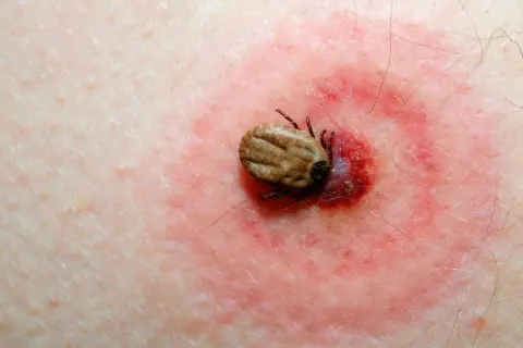 Cómo se llama la enfermedad de las garrapatas y sus riesgos ocultos