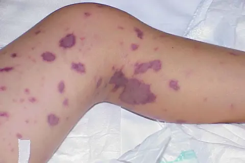 Piel con manchas moradas, un posible síntoma de meningitis.