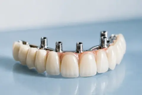 Protesi dentale fissa con denti staccati, fissata su pilastri metallici.