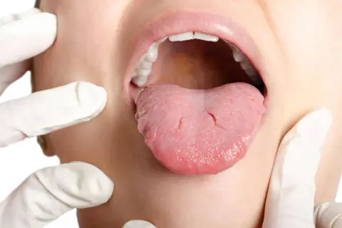 Arzt untersucht Zunge auf mögliche zungenkrebs symptome. Die Zunge ist herausgestreckt, die Lippen geöffnet.