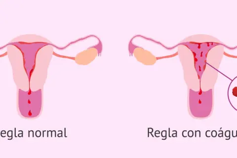 Comparación de úteros: uno muestra regla normal, el otro regla con coágulos. El embarazo y los coágulos menstruales son temas importantes.