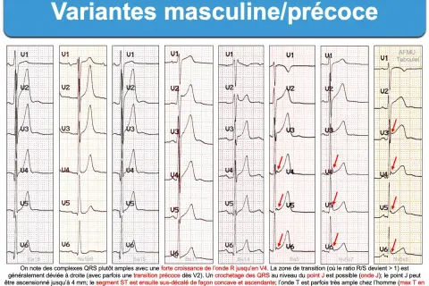 Variantes masculines/précoces : plusieurs tracés ECG montrant des variations de l'onde R et du segment ST, avec une transition précoce possible. Un ECG normal peut présenter ces caractéristiques.