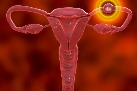 Ciąża pozamaciczna: objawy, które ratują życie. Działaj!