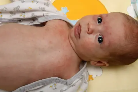 Jak leczyć rumień u dziecka - skuteczne metody i porady dla rodziców