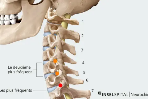 Anatomie du rachis cervical, montrant les localisations des hernies discales. Le temps de guérison d'une hernie cervicale dépend de sa gravité.