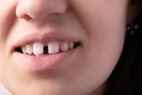 Diastema: Czy szpara między jedynkami to problem? Jak ją leczyć?