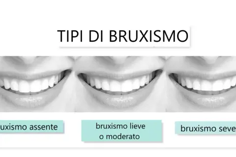 Tre immagini di sorrisi mostrano diversi gradi di bruxismo: assente, lieve/moderato e severo.