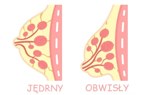 Ilustracja porównuje jędrny i obwisły biust, pokazując różnice w jego strukturze. Szukasz domowych sposobów na ujędrnienie biustu?