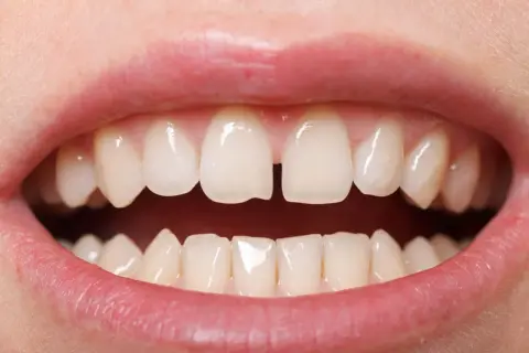 Szczelina między zębami, czyli diastema, jest widoczna na zbliżeniu uśmiechu.