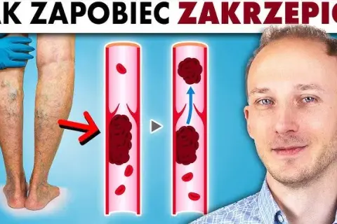 Zakrzepica jaki lekarz: jak uniknąć błędnych decyzji medycznych