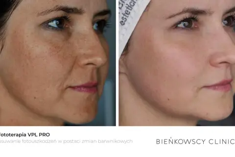 Przed i po fototerapii VPL PRO: widoczna redukcja przebarwień hormonalnych i plam posłonecznych na skórze twarzy.