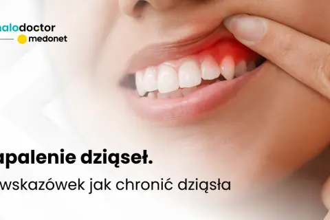 Zapalenie dziąseł: co robić, by uratować dziąsła i zęby? Poradnik.