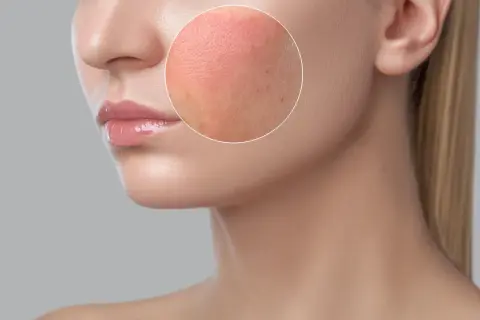 Gros plan sur une joue avec une tache rouge, montrant la texture de la peau et quelques imperfections.