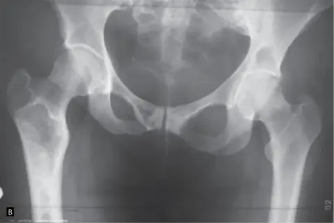 Czym jest ognisko osteolityczne? Przyczyny, objawy i diagnostyka zmian w kościach