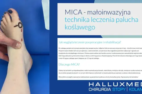 Jak zrobić opatrunek po operacji haluksa - uniknij błędów i bólu