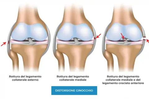 Illustrazione di ginocchia con lesioni ai legamenti: rottura collaterale esterno, mediale e combinata. Il dolore ai legamenti del ginocchio può variare.
