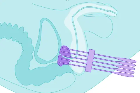 Illustration zeigt die Platzierung von Sonden für die Prostatakrebs-Strahlentherapie im Beckenbereich.