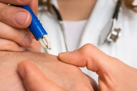 Jak wyjmować kleszcze - skuteczne metody, które zmniejszają ryzyko zakażenia