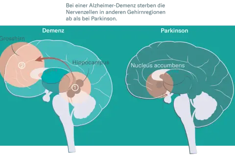 Gehirnschnitt zeigt Unterschiede bei Demenz und Parkinson. Bei Alzheimer-Demenz sterben Nervenzellen im Grosshirn und Hippocampus ab.