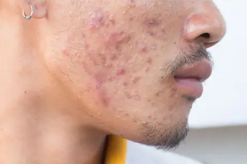 Visage d'un homme avec de l'acné. Une solution à base de rétinoïdes médicament pourrait aider à traiter ces imperfections.