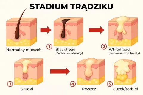 Ilustracja pokazuje etapy rozwoju trądziku na twarzy: od normalnego mieszka, przez zaskórniki, grudki, pryszcze, aż do guzków/torbieli.
