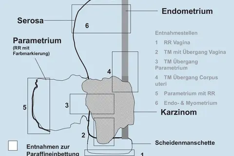 Schema zur Entnahme von Gewebeproben bei Zervixkarzinom. Markiert sind Serosa, Parametrium, Endometrium und Entnahmestellen.