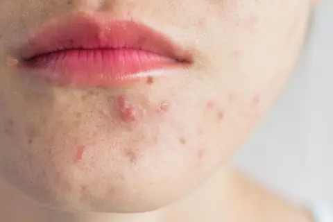 Nahaufnahme von Lippen und Kinn mit fettiger Haut und Pickeln.