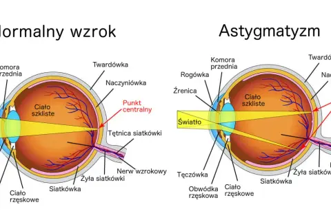 Czy da się wyleczyć astygmatyzm? Poznaj skuteczne metody leczenia