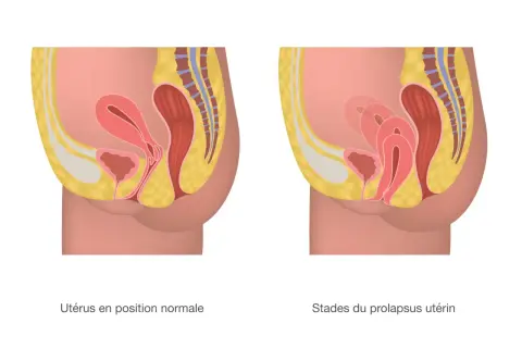 Comparaison d'un utérus en position normale et d'un prolapsus utérin stade 4, où l'organe descend significativement.
