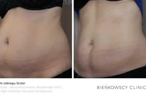 Wiotka skóra po odchudzaniu? Ujędrnij brzuch dietą, ćwiczeniami, pielęgnacją