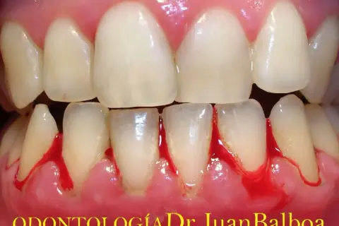 Encías inflamadas y sangrantes, un claro signo de gingivitis. La salud bucal es importante.