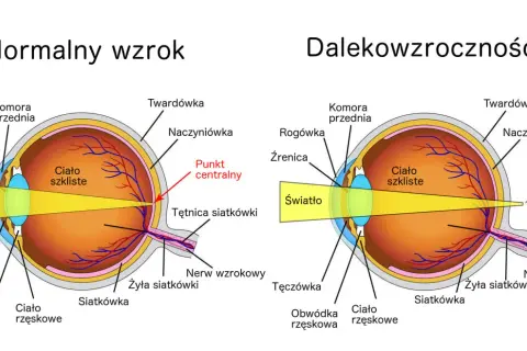 Na czym polega dalekowzroczność? Obraz pokazuje, że światło skupia się za siatkówką, a nie na niej, co powoduje nieostre widzenie.