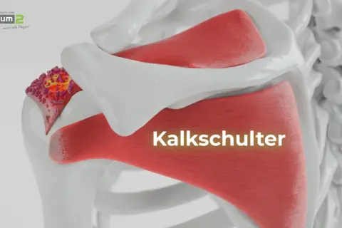 Kalkschulter: Ablagerungen im Schultergelenk. Was tun? Hier sehen Sie die Darstellung einer schmerzhaften Kalkschulter.