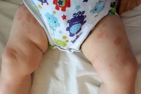 Czerwone plamy na skórze dziecka, widoczne na udach i w okolicy pieluszki, mogą wskazywać na alergię na BMK.