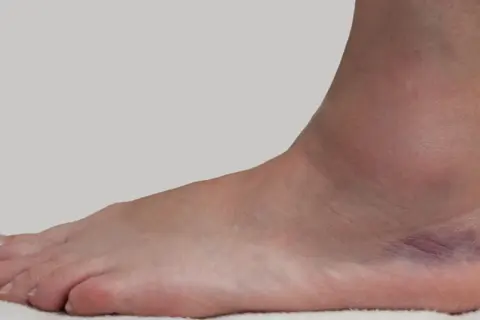 Geschwollener oberer Sprunggelenk mit blauen Flecken nach einer Verletzung.