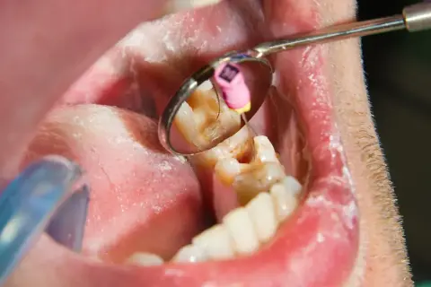 Widok jamy ustnej z lustrem dentystycznym, ukazującym ząb z widocznym stanem zapalnym, sugerującym nieleczony ropień zęba.