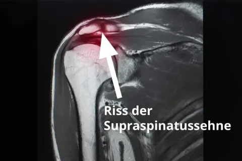 MRT-Aufnahme zeigt Riss der Supraspinatussehne. Erfahrungen mit Schulter-OP nach Sehnenriss.