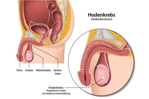 Anatomische Darstellung des männlichen Beckens mit Fokus auf den Hoden. Ein vergrößerter Hoden mit tastbarer Knotenbildung zeigt Hodenkrebs Symptome.