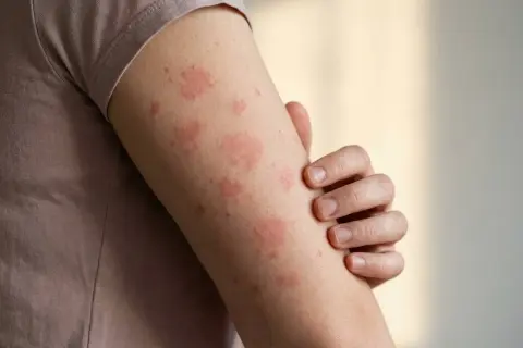 Haut rot aber kein Sonnenbrand: rote Flecken auf dem Arm, die jucken könnten.