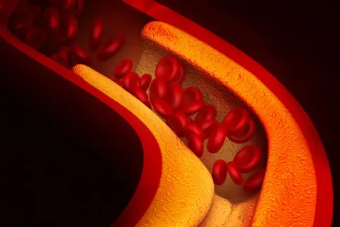 Cholesterol 200 czy to dużo? Sprawdź, co to oznacza dla zdrowia