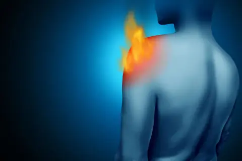Schulteransicht mit Flammen, die den entzündeten Schleimbeutel in der Schulter symbolisieren.
