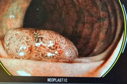 Bild visar en tarm med en stor, oregelbunden polyp. Detta kan vara en del av svaret på varför man får polyper i tarmen.