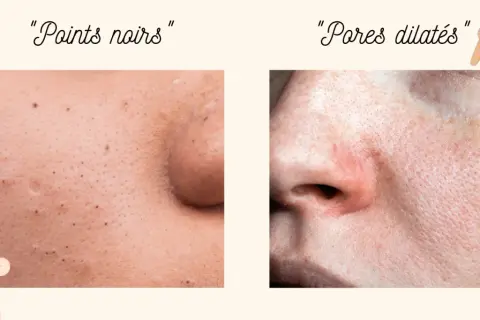 Comparaison de peau : points noirs et pores dilatés. Découvrez comment resserrer les pores pour une peau plus lisse.