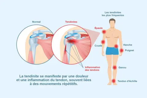 Illustration montrant une épaule normale et une épaule enflammée, avec les zones courantes de tendinites. Pour comment éviter tendinite, il faut comprendre l'inflammation des tendons.