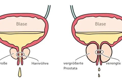 Vergleich von normaler und vergrößerter Prostata. Die vergrößerte Prostata kann zu verengter Harnröhre und damit zu Problemen beim Wasserlassen führen, ein mögliches Prostata Symptom.