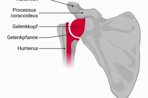 Anatomische Darstellung des Schultergelenks mit Humerus, Gelenkkopf, Gelenkpfanne, Acromion und Processus coracoideus. Eine inverse Schulterprothese ersetzt diese Strukturen.