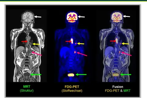 Ganzkörper-PET-CT-Bilder zeigen bösartige Herde. Pfeile markieren Auffälligkeiten in Gehirn, Brustkorb und Becken.