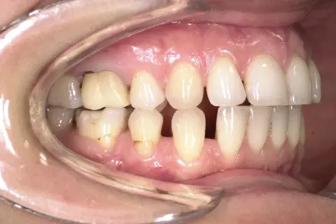 Denti con evidente overjet e overbite, alcuni incisivi superiori coprono quasi completamente quelli inferiori.