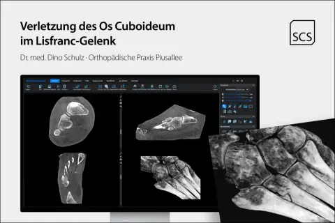 CT-Aufnahmen zeigen eine Verletzung des Os cuboideum im Lisfranc-Gelenk. Die Darstellung ermöglicht eine detaillierte Analyse der Knochenstruktur.