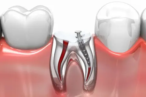 Wkład korzeniowo koronowy w zębie, pokazujący kanały korzeniowe i narzędzie dentystyczne.